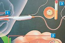 首次尝试泰国第一代试管婴儿的费用解读：如何预算最准确？